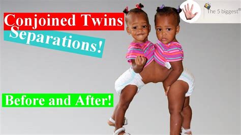 Riskiest Conjoined Twins Separations Before And After ~ Body Bizarre