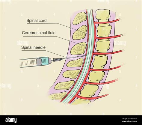 Lumbar Puncture Needle Hi Res Stock Photography And Images Alamy