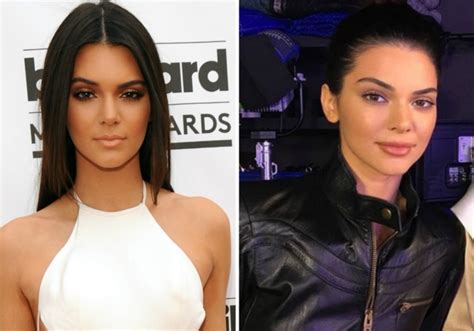 Kendall Jenner Before And After See The Pics That Have Fans