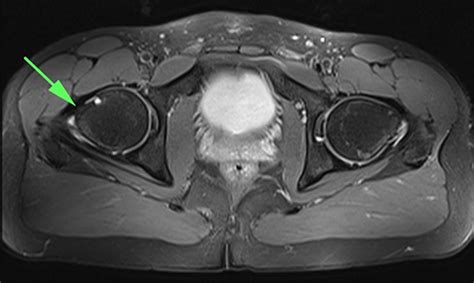 Axial Proton Density Fat Saturation Imaging Showing The Dysplastic Download Scientific