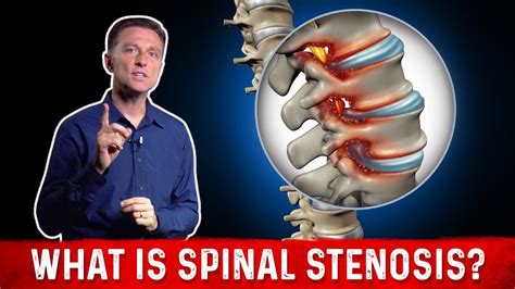 What Is Spinal Stenosis And It S Causes Explained By Dr Berg Youtube