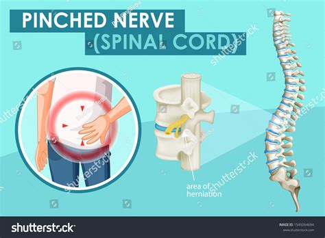 Diagram Showing Pinched Nerve Human Illustration Stock Vector Royalty
