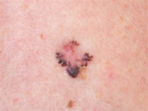 Basal Cell Carcinoma Symptoms Types And Pictures