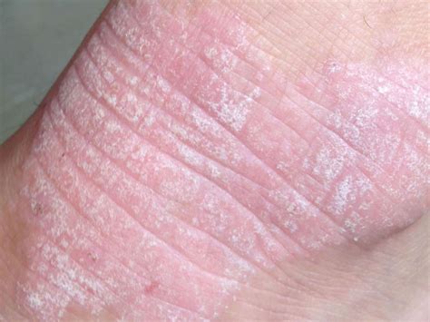 Dermatitis Herpetiformis Causes Treatment And Pictures