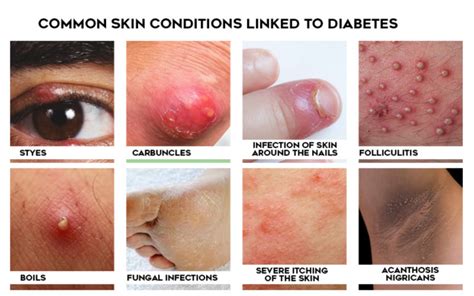 Diabetes Skin Problemsdiabetes Skin Rash