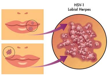 Ist das immunsystem dann aus irgendeinem grund geschwächt, sieht das virus seine chance gekommen: Lippenherpes (Herpes labialis) am Mund - Dauer, Behandlung >