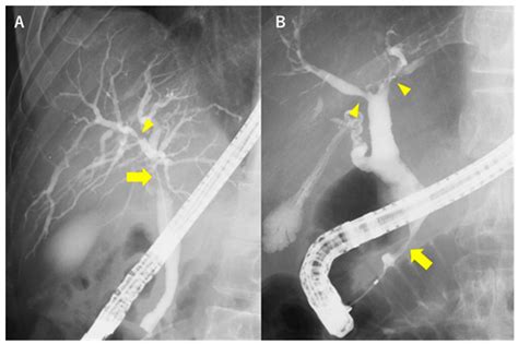 Diagnostics Free Full Text Role Of Peroral Cholangioscopy In The