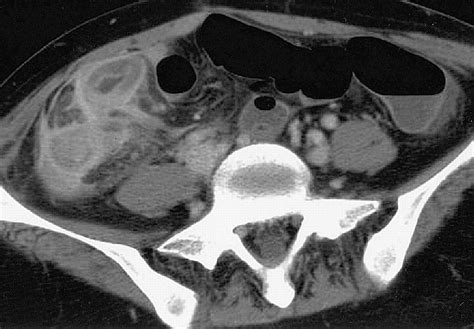 Cross Sectional Imaging In Crohn Disease Radiographics