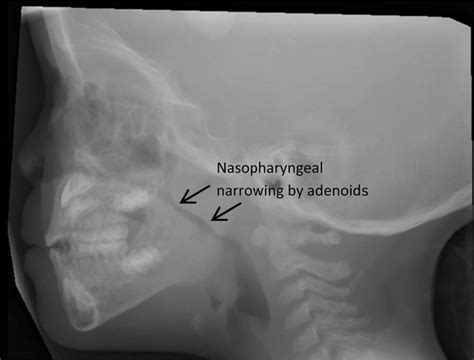Lateral Neck X Ray In A Child With Obstructive Sleep Apnoea Showing
