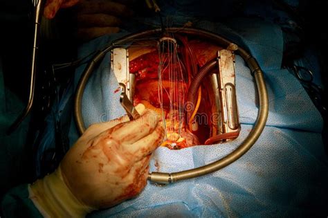 Heart Procedure Surgery Mechanical Replacement Valve Aortic