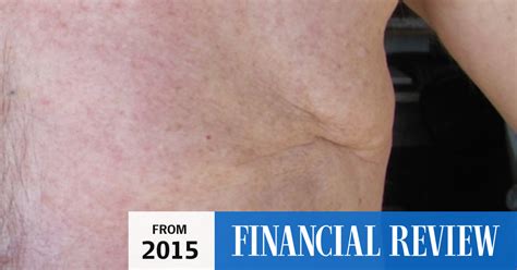 View of the female breast from the inside). Signs and symptoms of male breast cancer