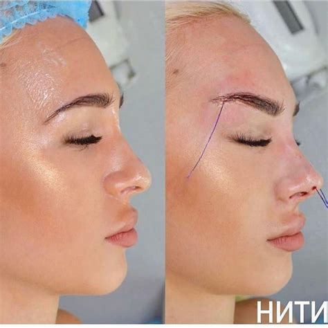 Achieve The Fox Eyes Look With Pdo Threading And Botox