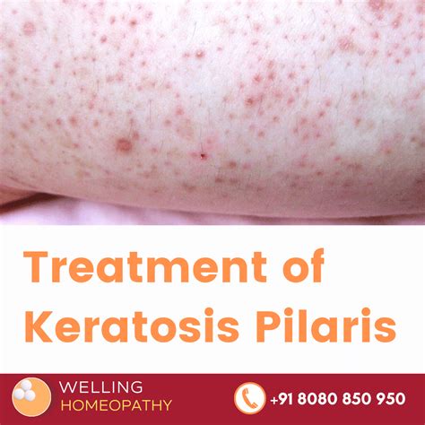 Homeopathy Treatment Of Keratosis Pilaris Best Homeopathy Doctor In India Us Uk Europe