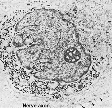 As up to 30% of patients who are radiologically node negative are found to. Electron micrograph of Merkel cell in the basal layer of ...