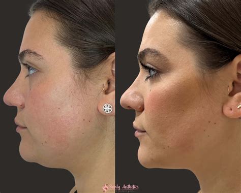 Kybella Fat Dissolving Before And After Results At Skinly