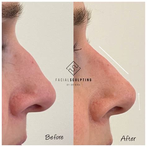 Dorsal Hump Nose Correction Facial Sculpting