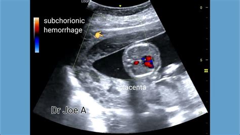 Subchorionic Hemorrhage And Hematoma In 2nd Trimester Pregnancy