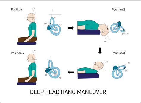 Deep Head Hang Maneuver To Treat Bppv