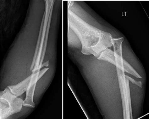 Figure Monteggia Fracture Contributed By Neal Johnson Md