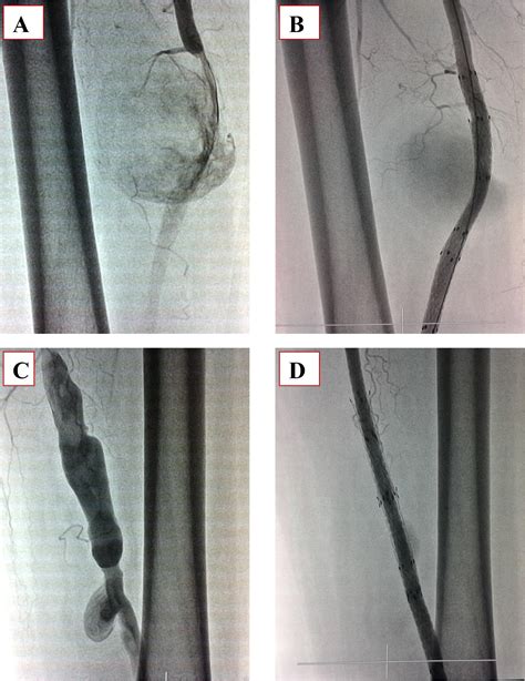 Endovascular Treatment Of Two True Degenerative Aneurysms Of