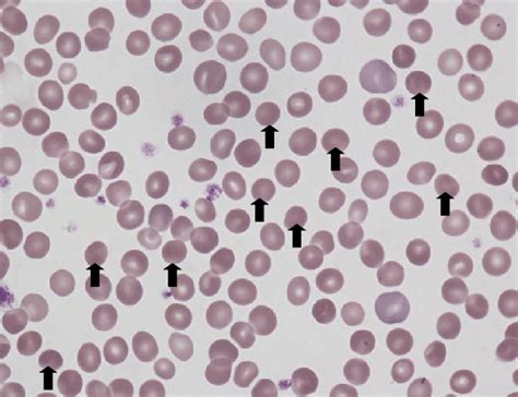 A family history of hs, early splenectomy, or gall bladder disease. Figure1.Peripheral blood smear (×1,000). Under normal conditions, red... | Download Scientific ...