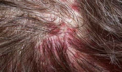 Red Bumps On Head Scalp