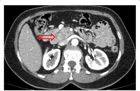 B Abdominal Enhanced Ct Scan With Pancreatic Time In Axial View