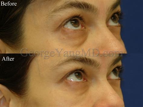 Lower Eyelid Filler 2604 George Yang Md New York Facial Plastic