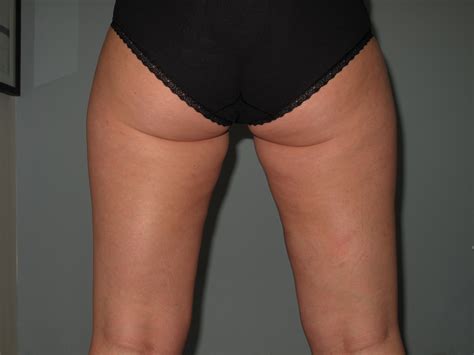 Dermatologist and cosmetic surgeon dr. St Louis Thigh Liposuction | Laser Lipo & Vein Center