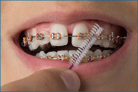 Tips To Care Teeth Braces Advice From Our Orthodontist Oris Dental