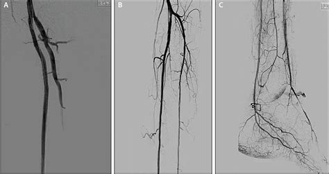 Peripheral Angiography — Dr Rasi Wickramasinghe Md Phd