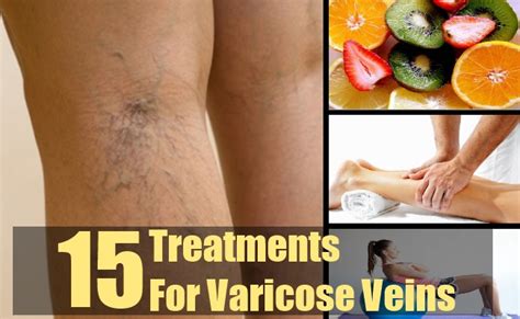15 Effective Treatments For Varicose Veins Natural Home