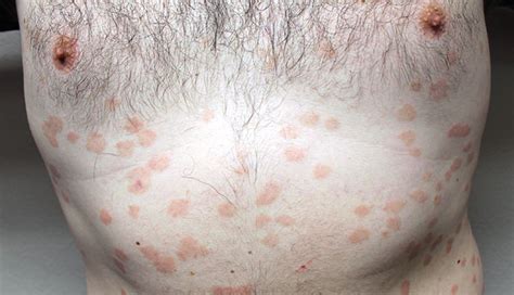 Hi, and thanks in advance. Derm Dx: Rash following a sore throat - Clinical Advisor