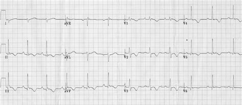 Sudden Syncope At Soccer • Litfl • Clinical Cases Ecg Exigency
