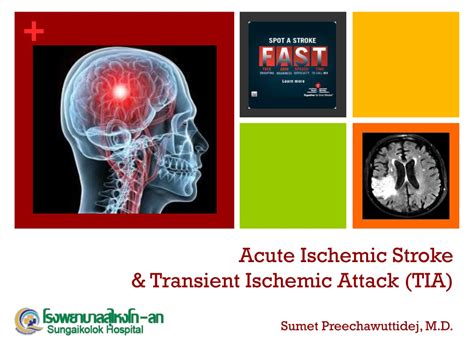 Ppt Acute Ischemic Stroke And Transient Ischemic Attack Tia Sumet