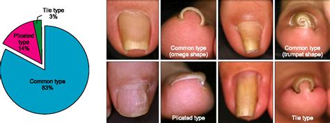 Figure 1 From A Clinical Study Of 35 Cases Of Pincer Nails Semantic