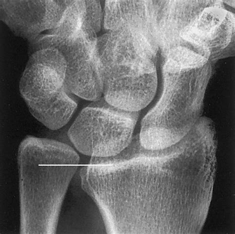 Imaging Findings In Ulnar Sided Wrist Impaction Syndromes RadioGraphics