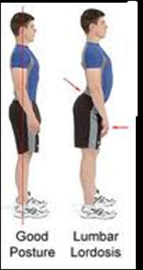Lumbar Lordosis This Deviation Commonly Referred To As A Swayback Can