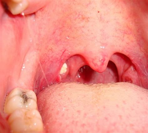 6 Alarming Symptoms Of Tonsilloliths That Should Never Be Ignored Life
