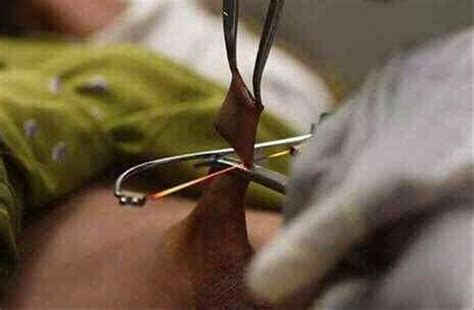 Jual Alat sunat laser . alat khitan laser SONIX LASER CARE ...