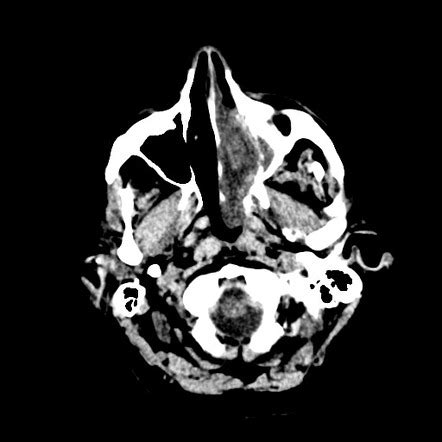 Sinonasal Adenocarcinoma With Later Dural Involvement Radiology Case