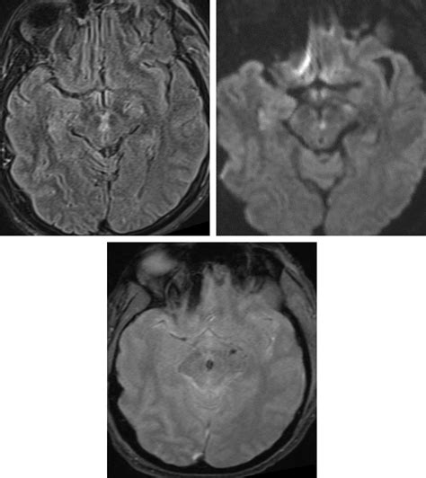 Subfalcine Herniation