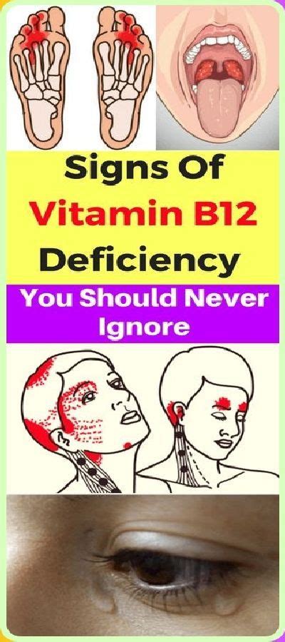 Here Are Warning Signs Of Vitamin B Deficiency B Deficiency