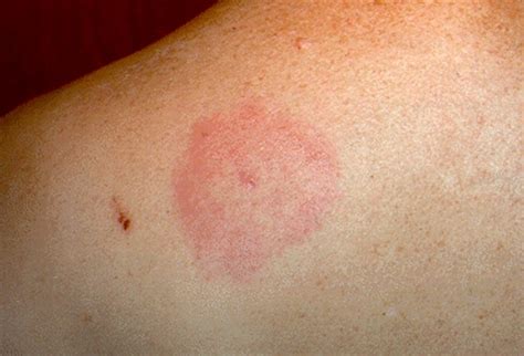 Lyme Disease Rash Pictures
