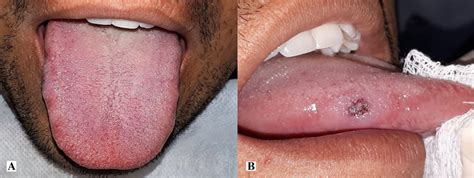 Clinical Appearance Of The Lesion A View Of The Dorsum Of The