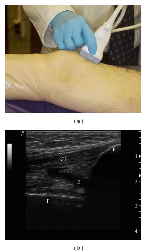 A Suprapatellar Longitudinal Scan Of The Knee B Ultrasound