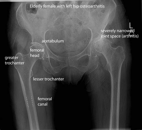 Pelvis Radiographic Anatomy Normal Vs Oa Medical Radiography Medical