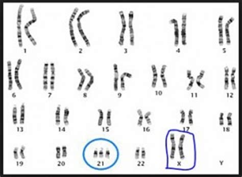 Karyotype down syndrome chromosomal abnormalities chromosomes microscope white blood cells. Paradoxical Genes: Down syndrome and female — Down Syndrome Prenatal Testing