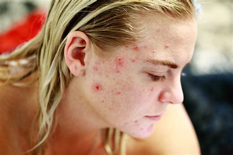 Acne Skincare 8 Simple Tips To Follow And Natural Ways To Cure Acne
