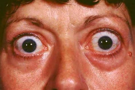 Causes Of Exophthalmos Symptoms And Treatment